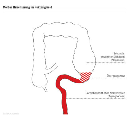 Morbus Hirschsprung - SoMA